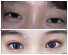 做過韓式三點式雙眼皮，可以再重新做雙眼皮+開眼角嗎？