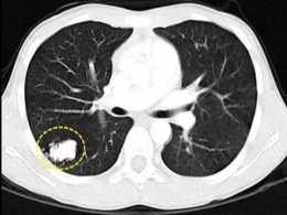 肺CT報告單的8大潛臺詞，看完你也是半個醫生