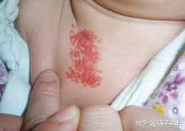 警惕！寶寶身上的“紅色胎記”可能是血管瘤