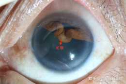 石頭崩傷一年後求醫，我的瞳孔還能恢復嗎？