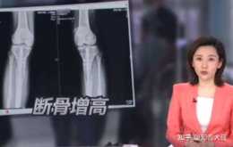 8年前，北京小夥花16萬斷骨增高7.2釐米，如今他怎樣了？