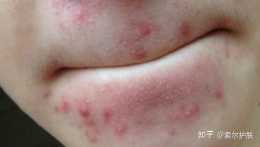 嘴巴周圍總長痘是什麼原因？索爾祛痘護膚分享